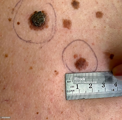 imagem melanoma