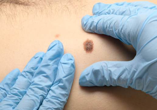 melanoma