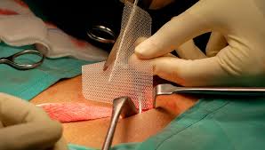 cirurgia de hérnia
